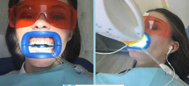 Сколько стоит отбеливание zoom