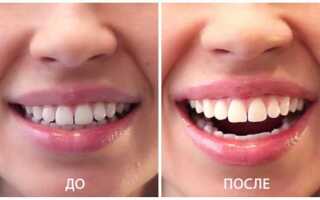 Что можно есть после отбеливания зубов zoom