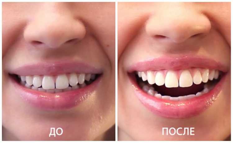 Что можно есть после отбеливания зубов zoom