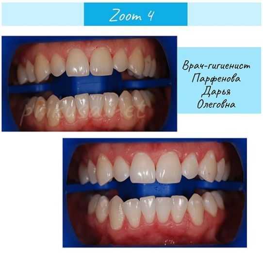 Что такое отбеливание zoom 4