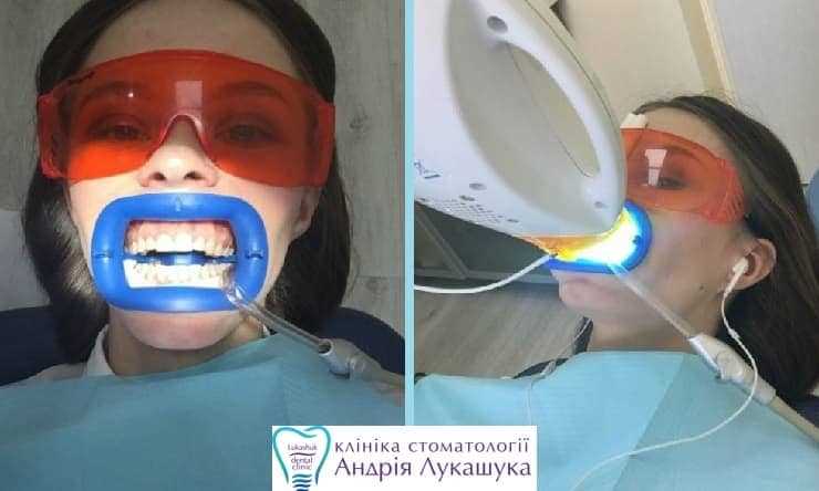 Факторы, усиливающие или уменьшающие боль после отбеливания