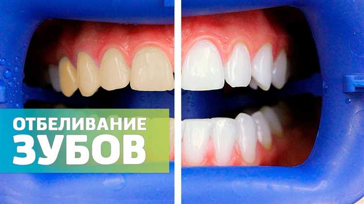 Средства и методы для снятия боли после Zoom-отбеливания