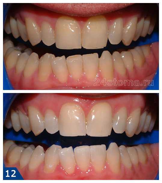 Рекомендации по подготовке к процедуре Zoom 4