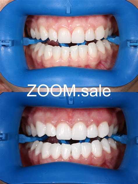 Что входит в стоимость процедуры отбеливания Zoom 4